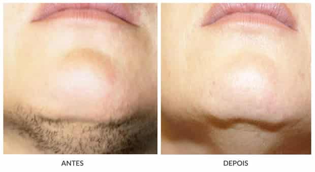 Foto publicada no artigo: Dra. Andreia Pamplona: Mitos e verdades da depilação a laser (imagem de cabeçalho do artigo)